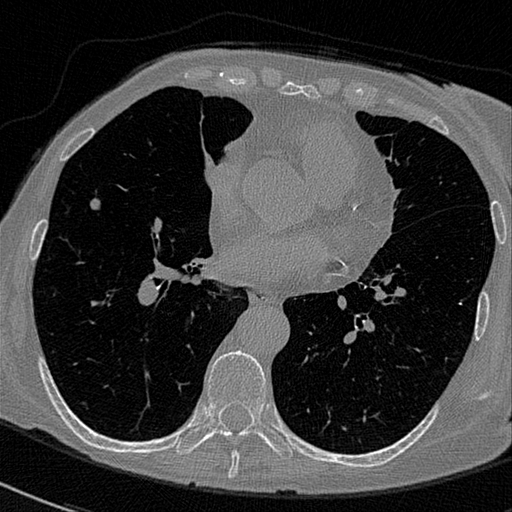 LIDC-IDRI-0140_143_280_CT_lung.png